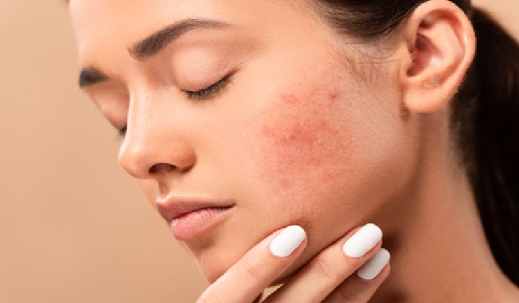  How To Treat Blemishes